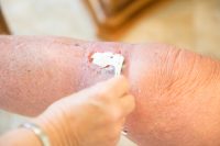 “피부에 바르는 연고 처방, 미국 3배 이상…허가된 경우는 34% 불과”