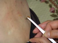 ‘침·뜸 등 평생교육 금지’ 법안 발의…의미는?