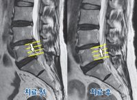 한의치료 받은 디스크환자 90%, 4년 후에도 “만족”