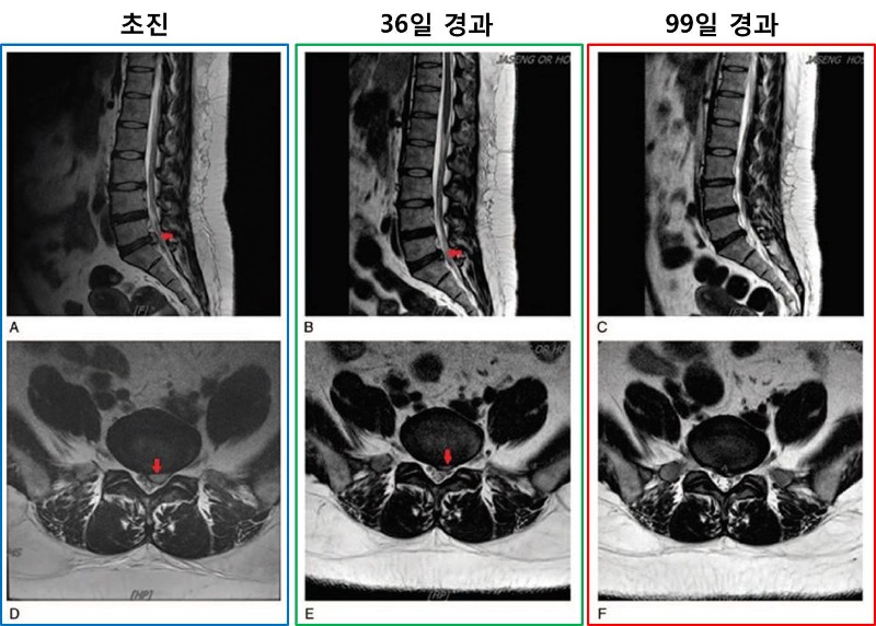 [사진설명] 치료에 따른 시간별 낭종 평가.jpg