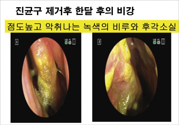 아기의 노란 콧물이 지속되는 유아 축농증 증상 항생제 처방