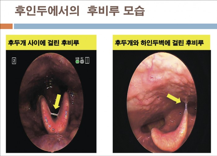라경찬한의원 | 후비루 | 비염한의원 8