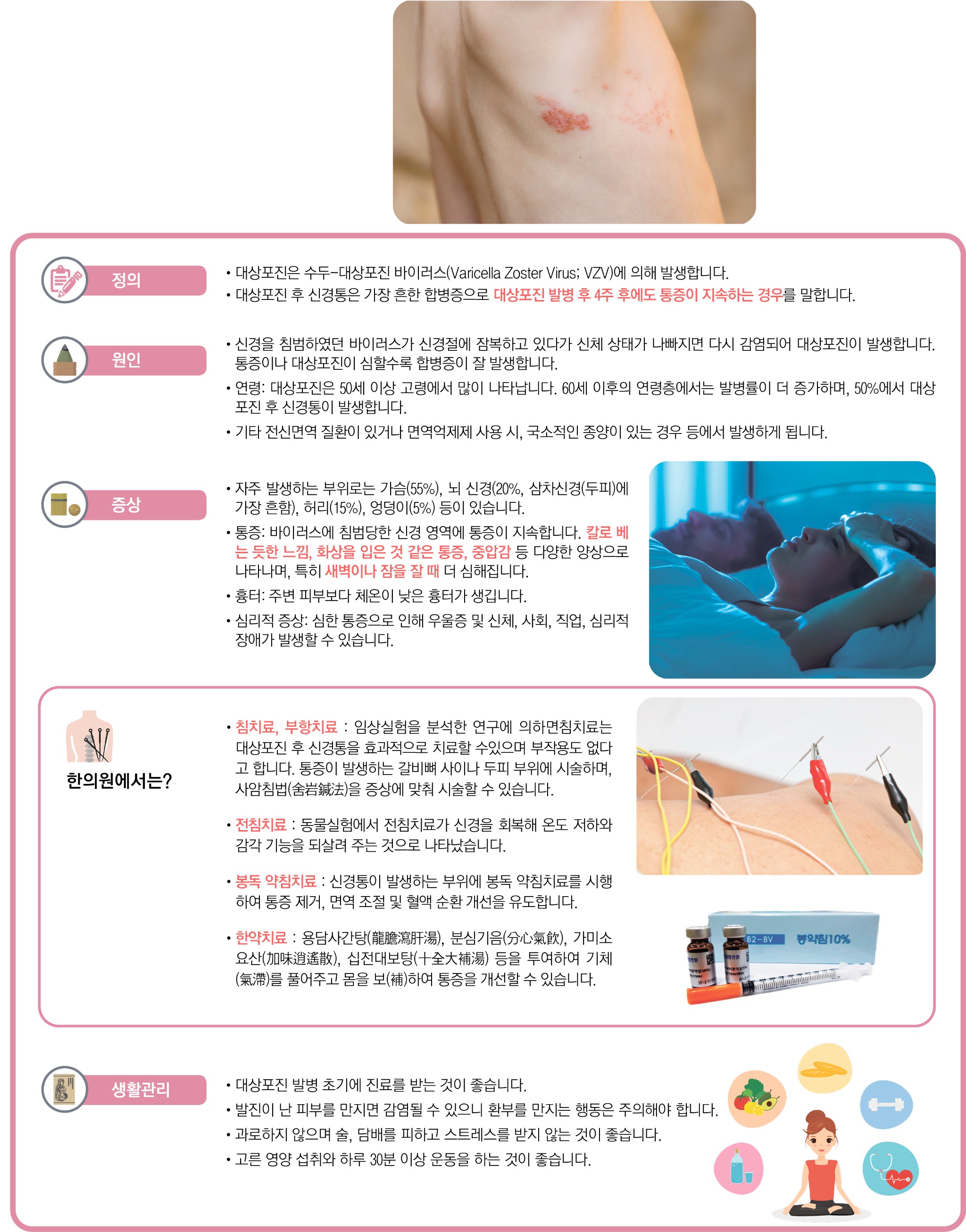 대상포진 후 신경통 .jpg