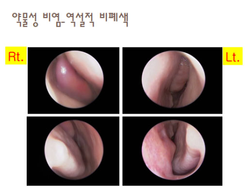 약물성 비염 복사.jpg