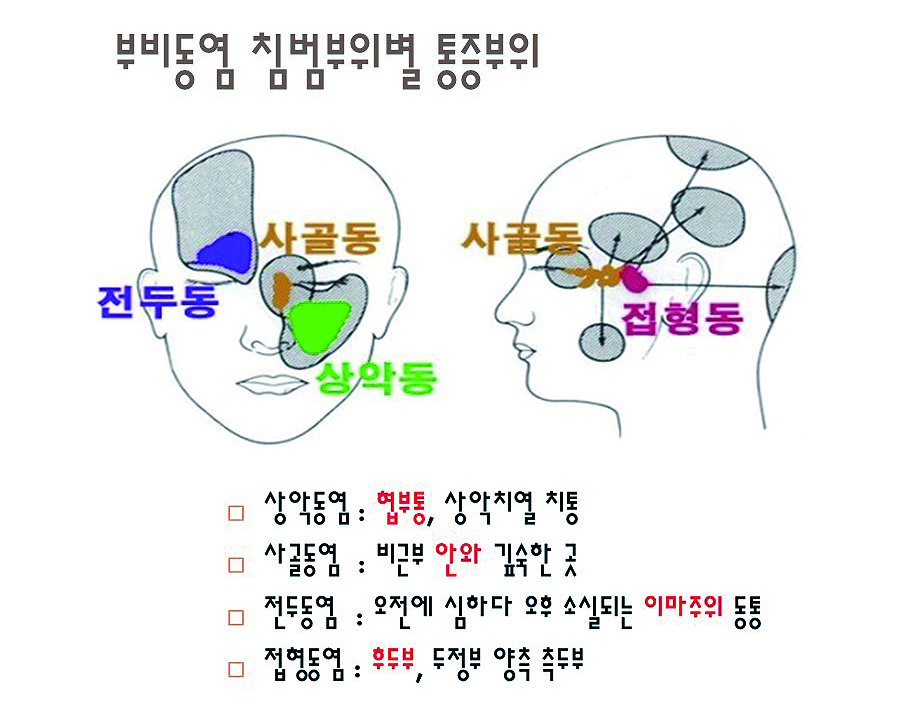 급성 폐쇄성 부비동염_01.JPG