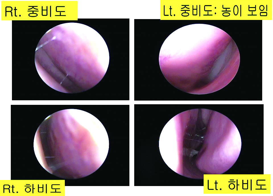 급성 폐쇄성 부비동염_02.JPG