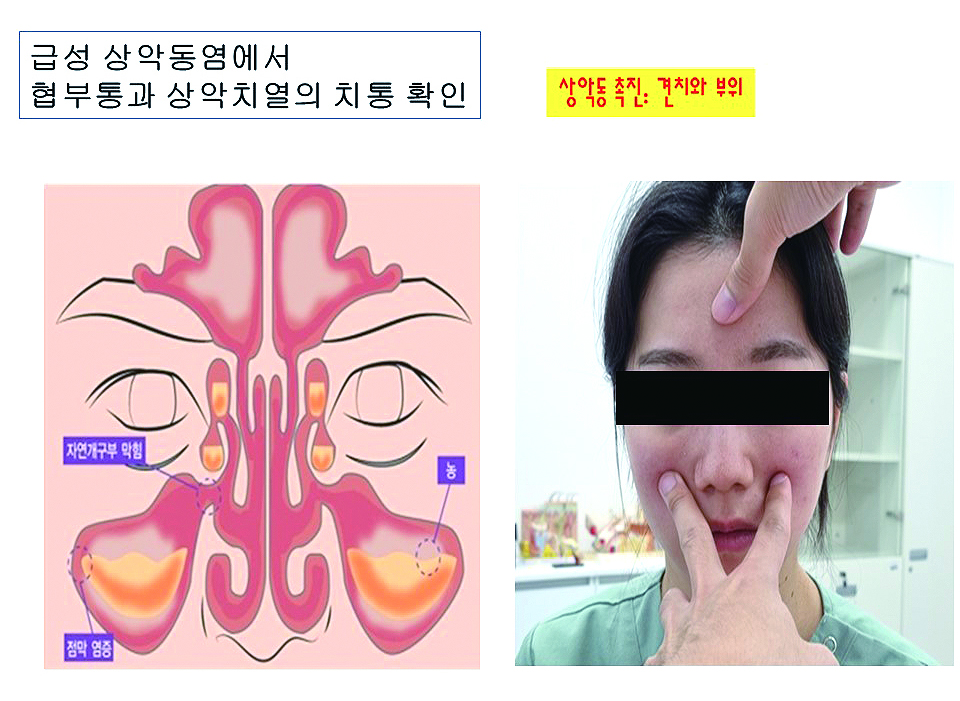 급성 폐쇄성 부비동염_03.JPG