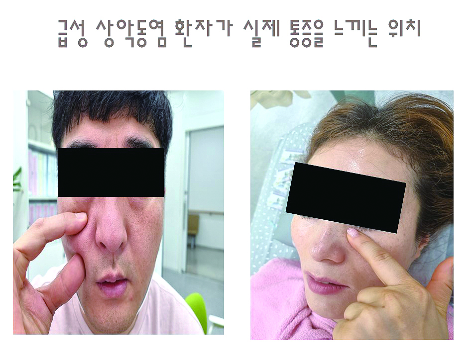 급성 폐쇄성 부비동염_04.JPG