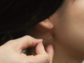 턱관절 장애에 침 치료, 부작용 없고 물리치료보다 ‘효과적’