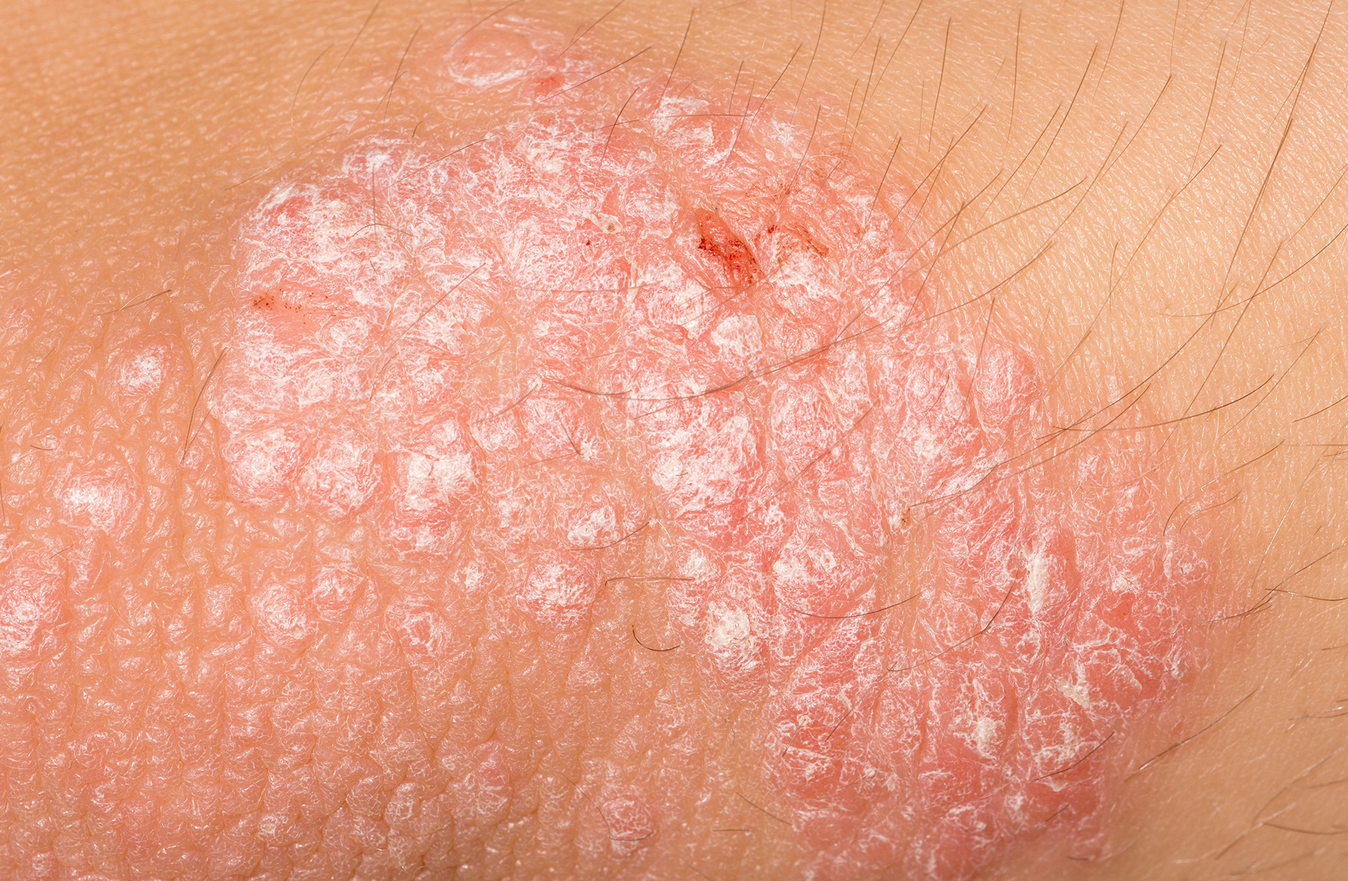 건선 김민서 박사2.jpg