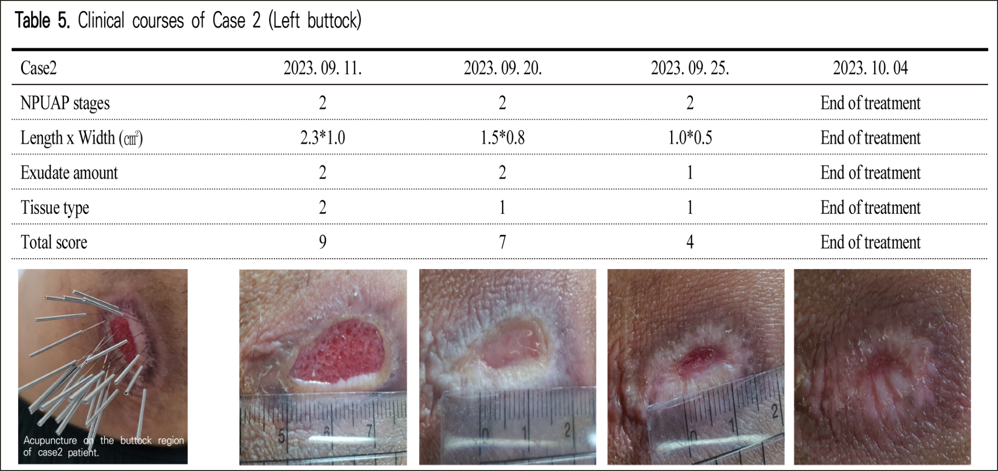 욕창 3례 논문3.png