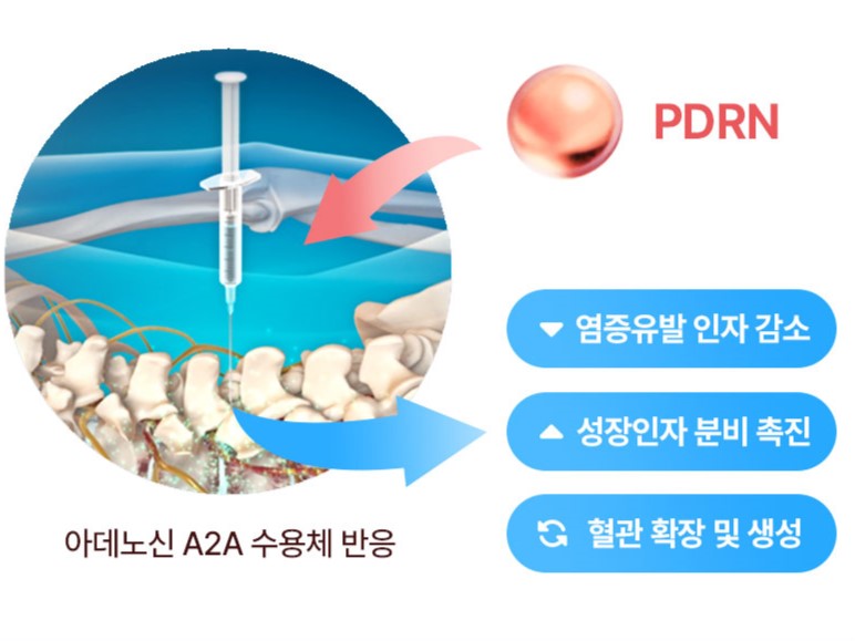 [사진설명] PDRN성분 약침 치료 기전.jpg