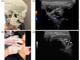 초음파 활용 침 치료, 만성 알레르기 비염·부비동염에 ‘효과’