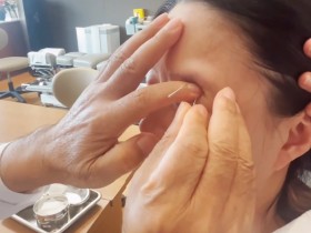 동안신경마비 환자 회복에 한의치료 ‘효과적’