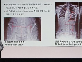 X-ray로 보는 척추 균형…한의공공의료의 진단 패러다임 전환