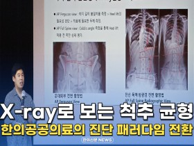 [자막뉴스] X-ray로 보는 척추 균형, 한의공공의료의 진단 패러다임 전환