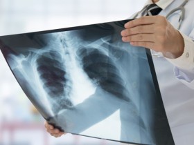 X-ray 결핵 진단률 0.004% 수준…“3700억 건보 누수”