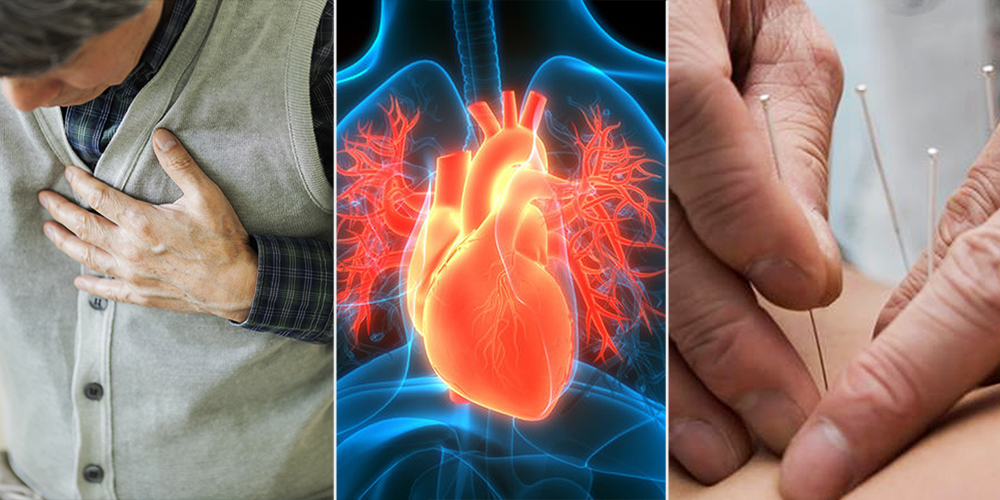 “침 치료, 허혈성 심질환 노인 환자 5년 사망률 46%까지 낮춰”