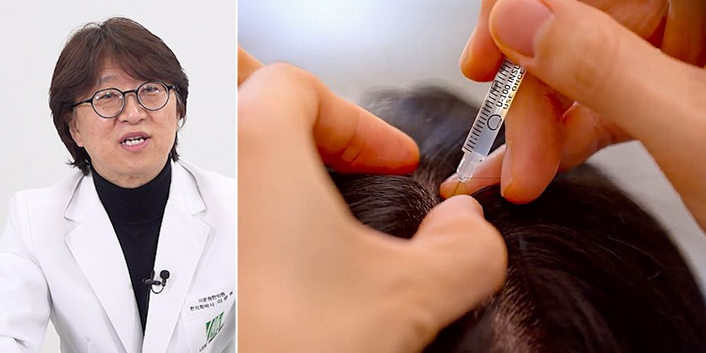 탈모 치료, 약침의 ‘소염·자음·보혈’ 3축 관리법으로 패러다임 전환