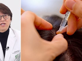 탈모 치료, 약침의 ‘소염·자음·보혈’ 3축 관리법으로 패러다임 전환