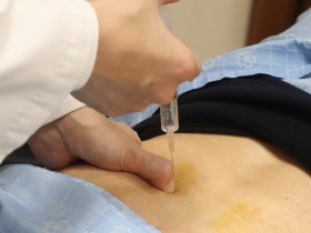 척추관협착증 약침치료, 물리치료보다 회복속도 2.3배 빨라