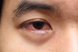 background of red sore allergy eye