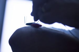 Dry needling electroacupunture needles used by acupunturist physiotherapist on patient in pain and injury acupunture with electrical pulse treatment. No model releases or property releases required as no recognisable people and generic objects.